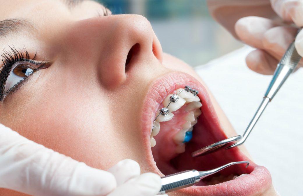 您需要了解的關於箍牙治療的知識